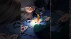 Surgeons Removes A Massive Parasite From Patient’s Body