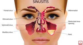 Doctor Shows How To Clear A Stuffy Nose By Draining The Sinuses!