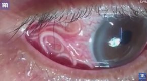 Graphic : Moment 15cm Long Worm is Removed From Mans Eye