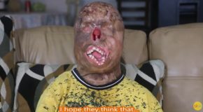 The Miracle Burn Survivor who Lost His Face