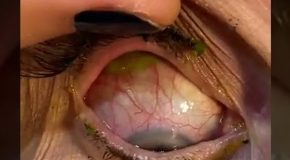 Doctor Removes An Absolutely Massive Earwax From A Man’s Ear